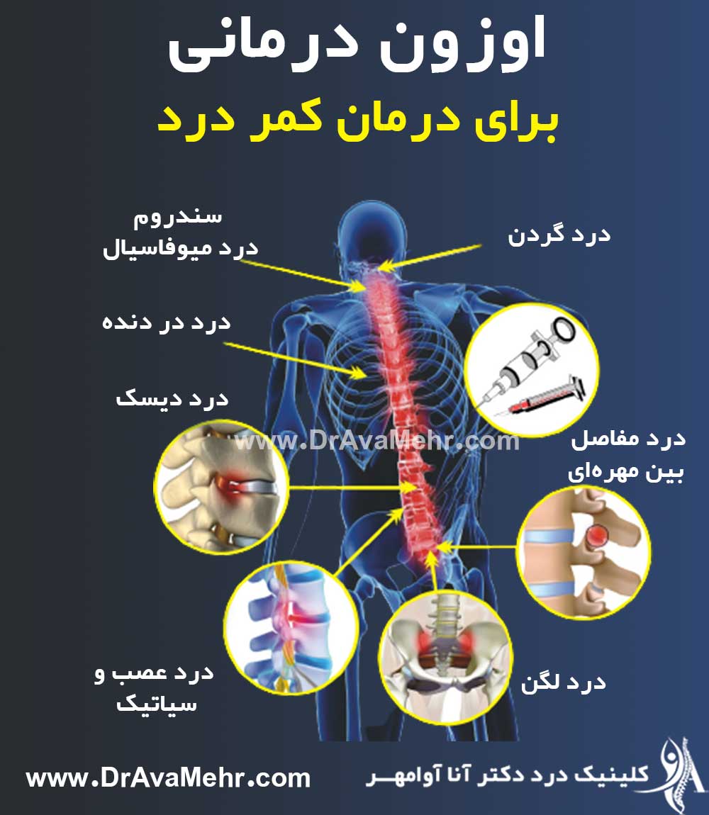 اوزون تراپی دیسک کمر