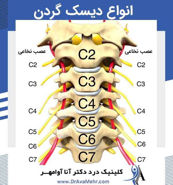 انواع دیسک گردن
