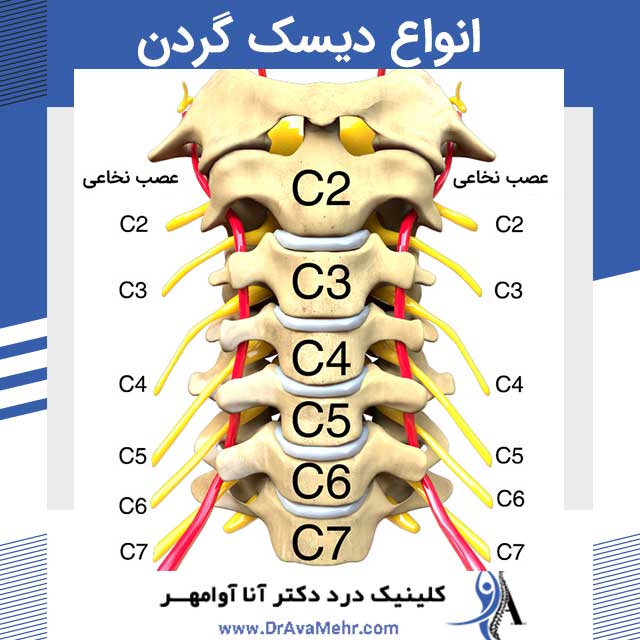 انواع دیسک گردن