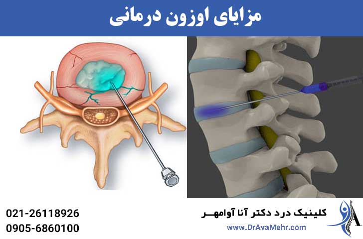 مزایای اوزون درمانی