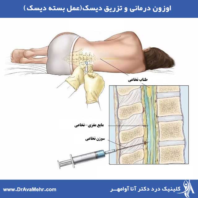 اوزون درمانی دیسک کمر