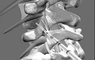 اوزون تراپی