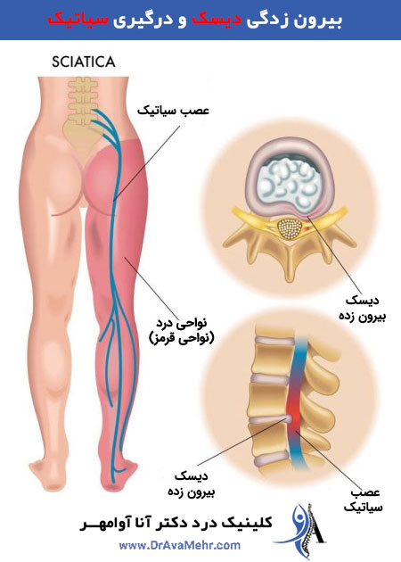 عکس رابطه بین دیسک کمر و درد سیاتیک