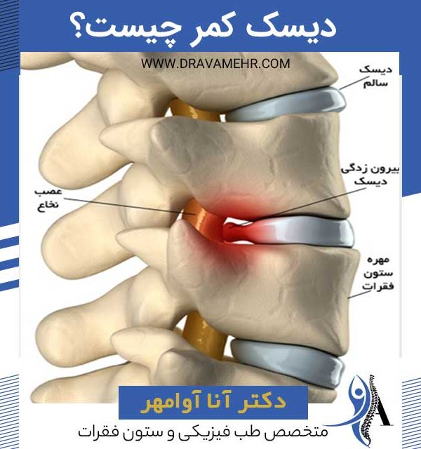 دیسک کمر چیست