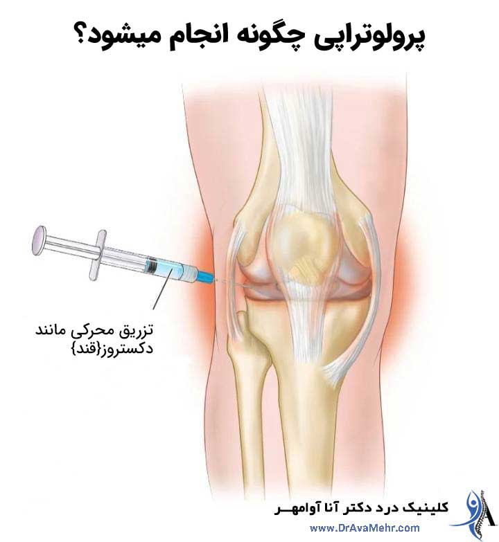پرولوتراپی چگونه انجام می شود؟