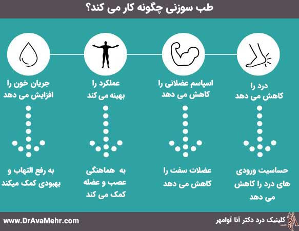 نحوه انجام طب سوزنی