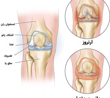 آرتروز زانو