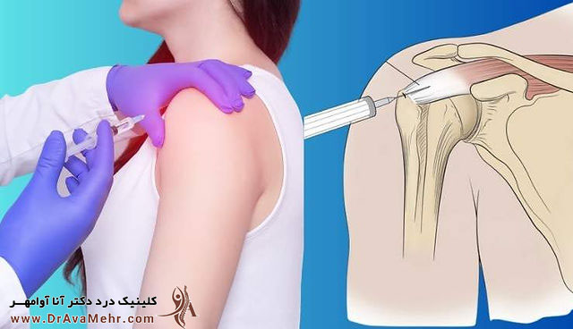 تزریق prp به شانه