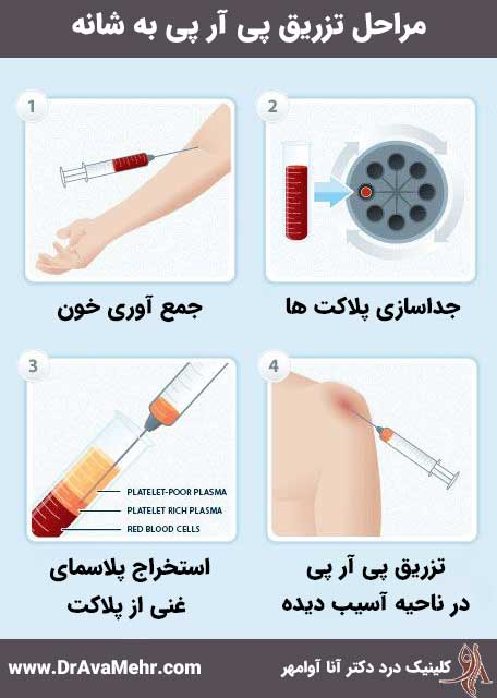 نحوه انجام عمل تزریق پی آر پی به شانه