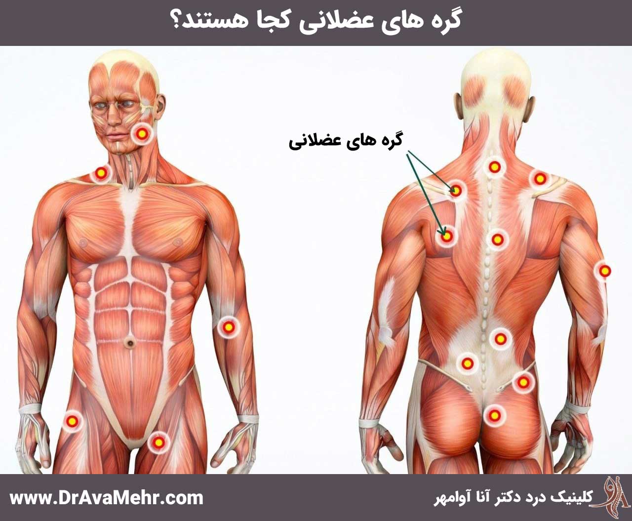 گره های عضلانی کجاست