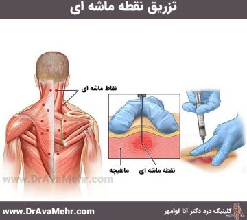 نحوه تزریق نقطه ماشه ای