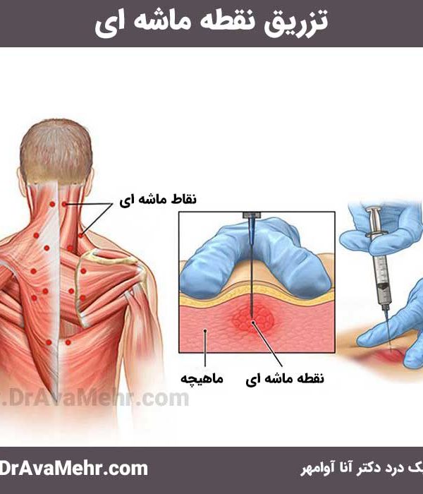 نحوه تزریق نقطه ماشه ای