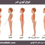 انواع گودی کمر