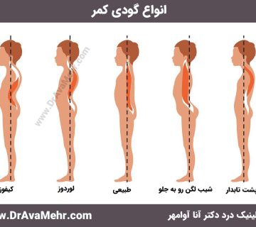انواع گودی کمر