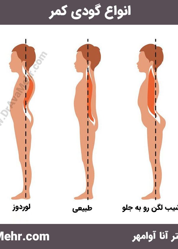 انواع گودی کمر